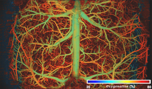 Brain Hypoxia