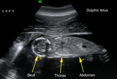 Y37 Fetus Ultrasound
