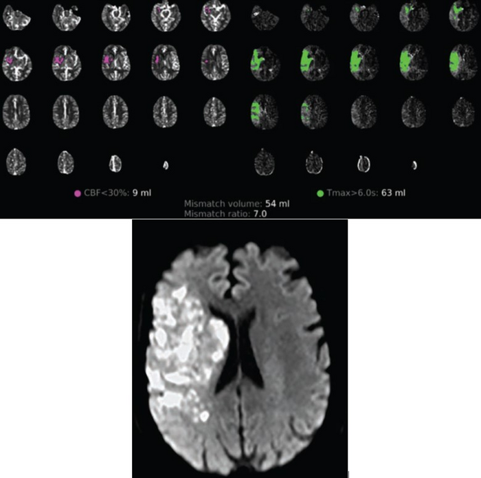 54-year-old patient with COVID-19 who underwent full angiographic reperfusion (extended thrombolysis in cerebral ischemia score = 3) after acute ischemic stroke