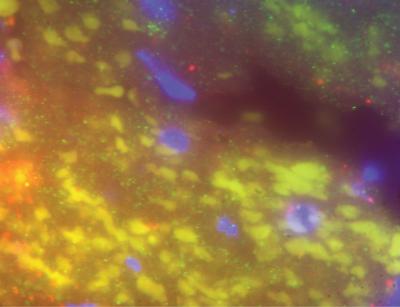 Platelet Expression of MRP-8/14 in Human Coronary Artery Thrombus