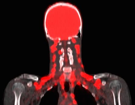 Brown Fat on a PET Scan