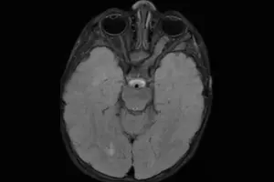 NF1-linked optic glioma