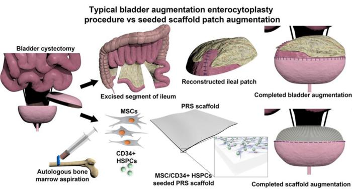 Bladder augmentation