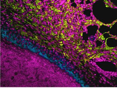 Micrograph of <i>S. aureus</i> Skin Abscess