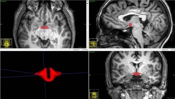 Study Finds Key Brain Region Smaller in Birth Control Pill Users