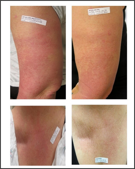 Photographs of a patient with dermatomyositis with refractory skin disease before and after taking lenabasum