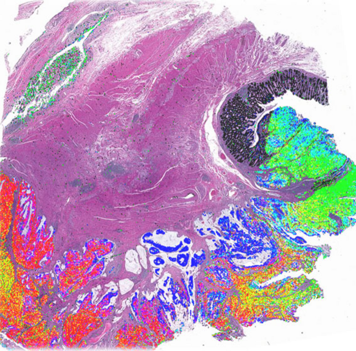 Integrated image of colorectal cancer