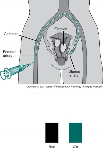 Uterine Fibroid Embolization