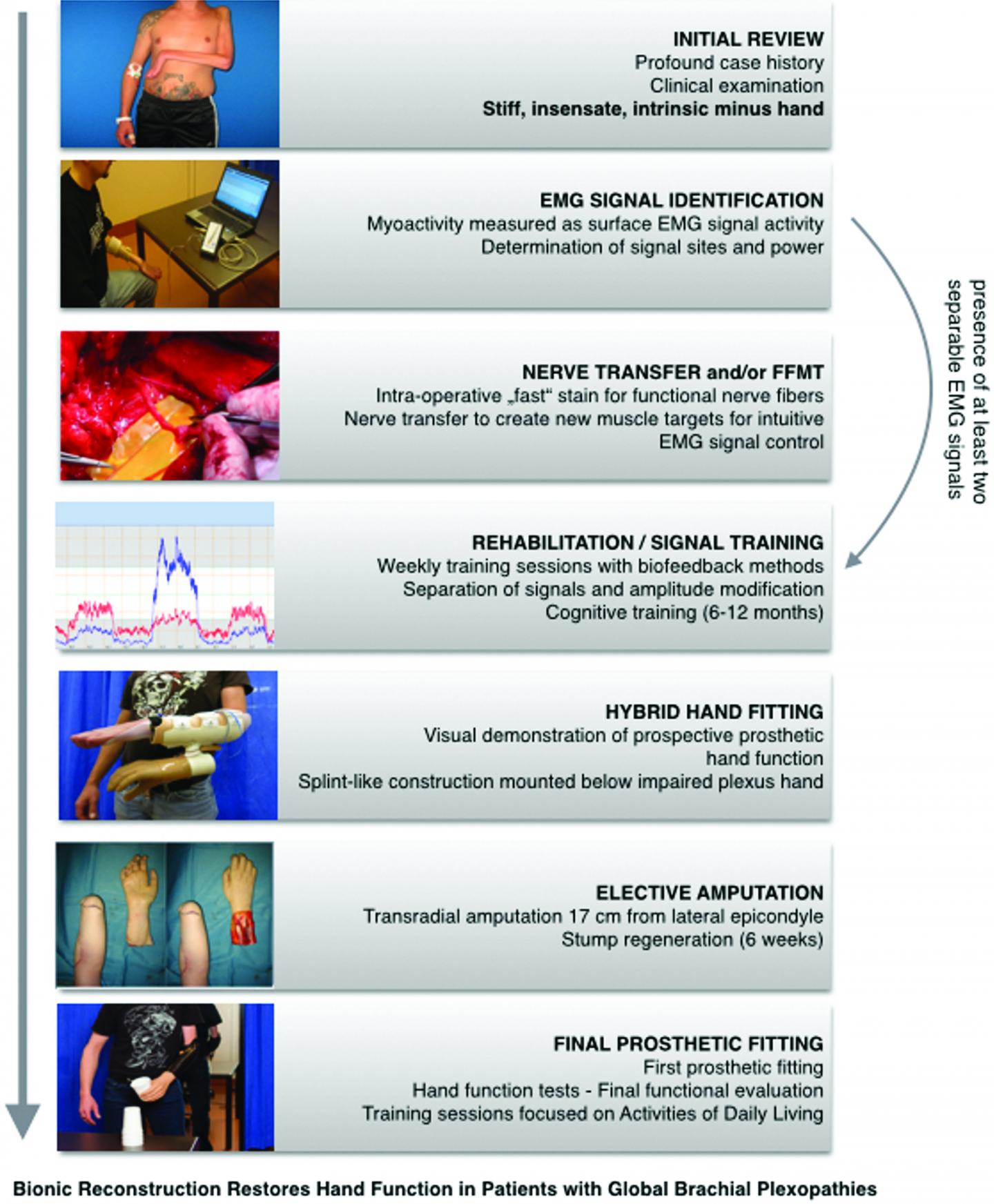 Algorithm for Bionic Hand Reconstruction in Patients with Global Brachial Plexopathies