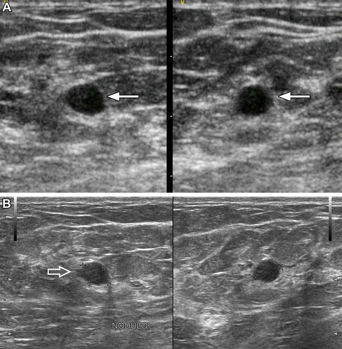 AI Helpful in Triaging Breast Masses in Low-Resource Areas
