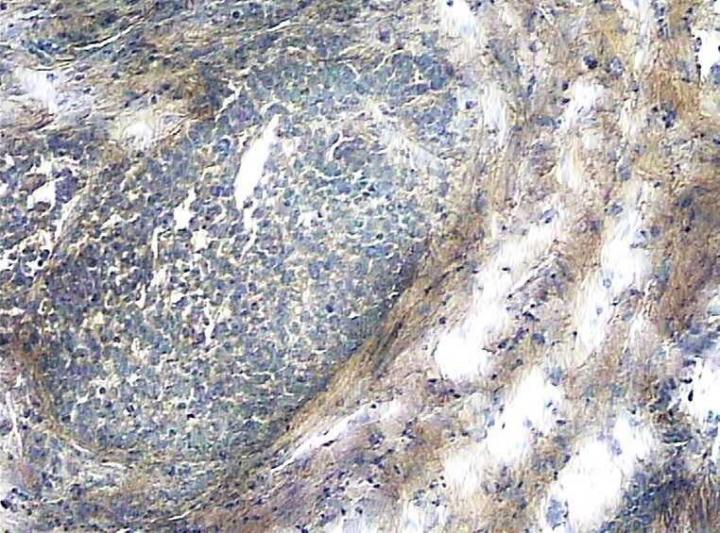 Ovarian Cancer Slide