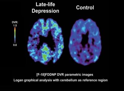 FDDNP Imaging and Depression