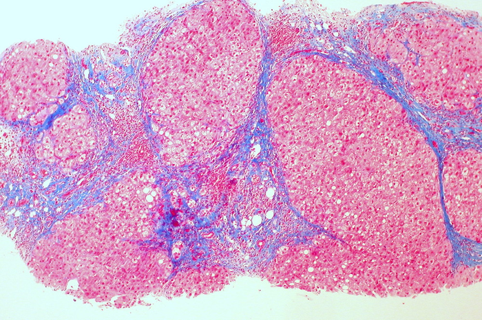 Liver Cirrhosis