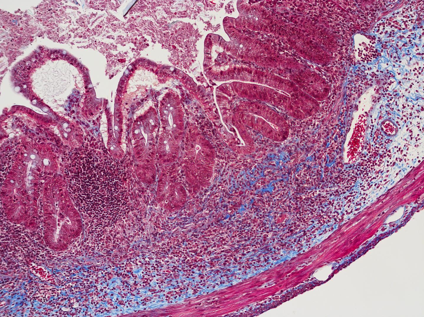 On the Road to Therapy for Crohn's-Related Fibrosis (8 of 9)