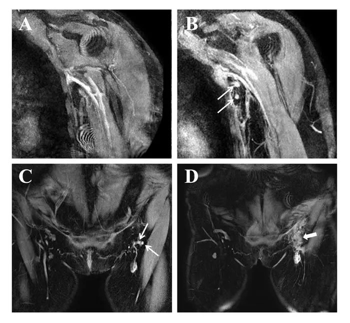 Visualization of lymph nodes at the axillary and inguinal regions on MRL before and after surgery.