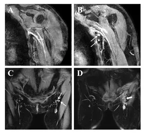 Visualization of lymph nodes at the axillary and inguinal regions on MRL before and after surgery.