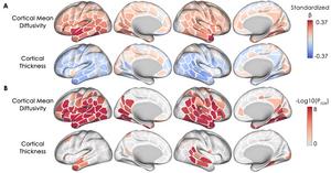 Longitudinal changes in cortical mean diffusivity and cortical thickness