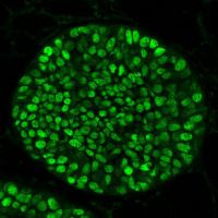 Immunofluorescence Staining on a Breast Cancer