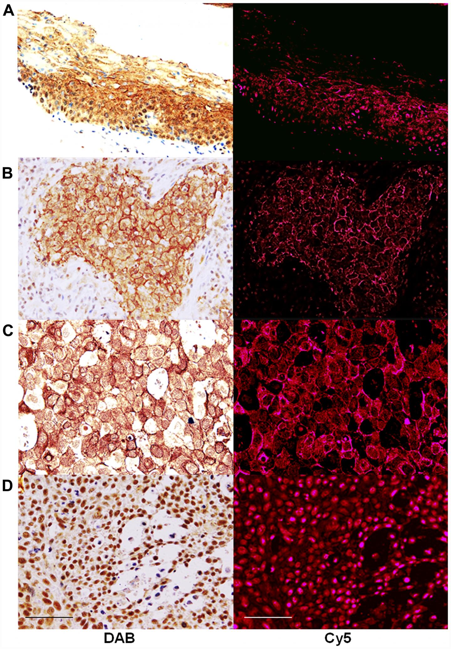 Expression of CLDN4 in Oral Squamous Cell Carcinomas