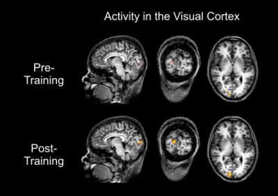 Functional MRI Scan Shows How the Brain Changes through Neurofeedback Training