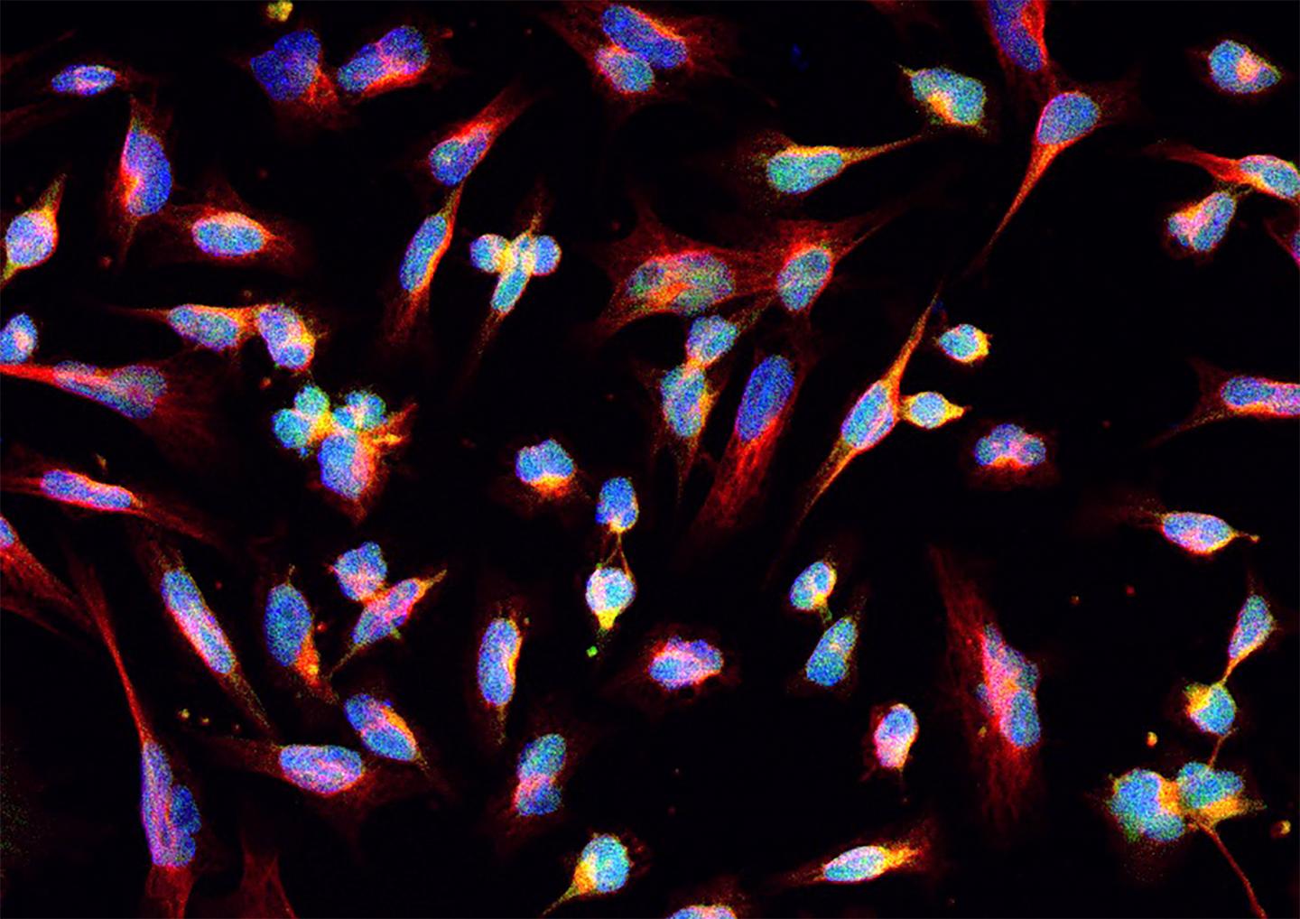 A Blueprint for Combating a Common Brain Cancer