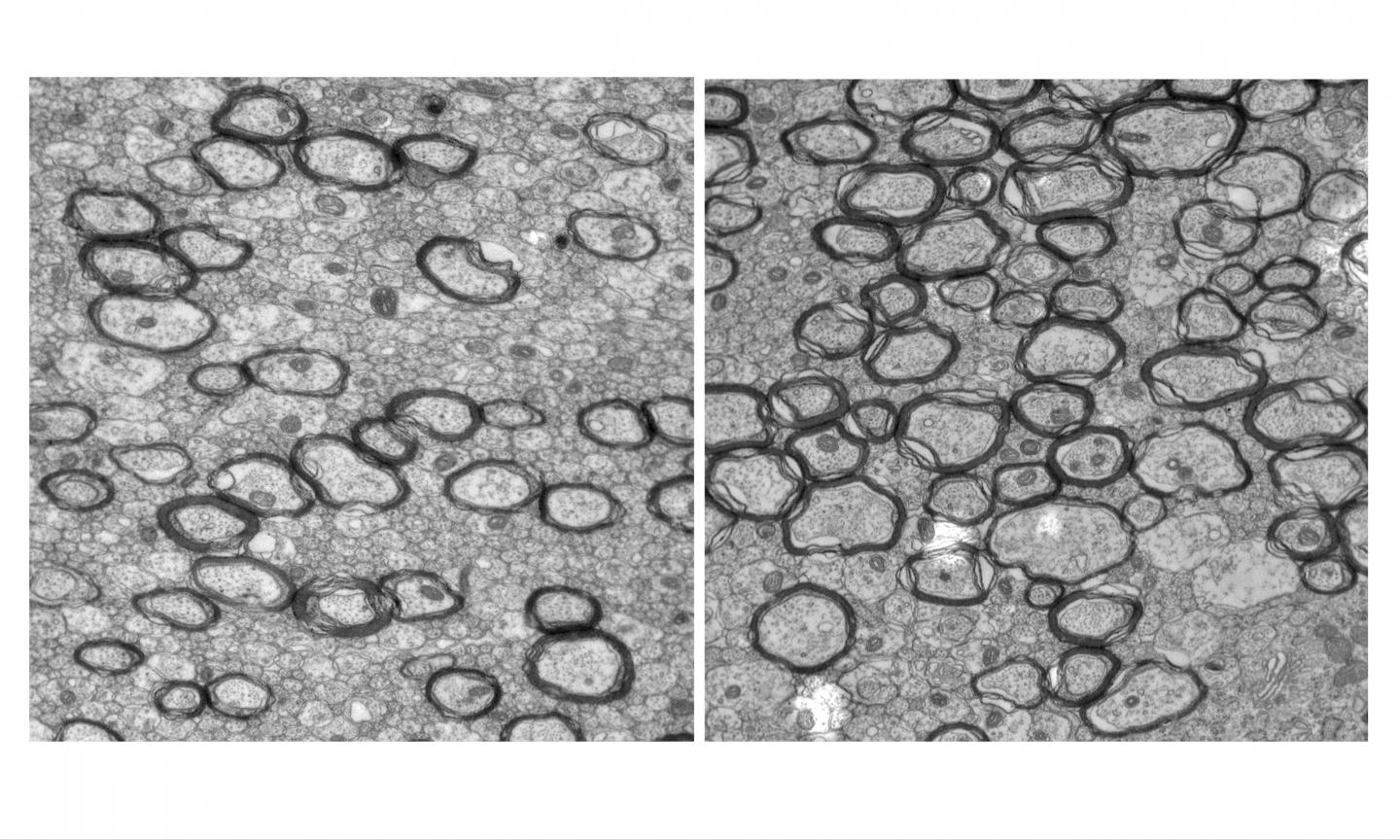 Treatment to Calm Hyperactive Brain Immune Cells