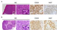 IMAGE 2: B-Cell Lymphomas Developed in the Lymp Nodes of miR-146a and MiR-146b KO Mice