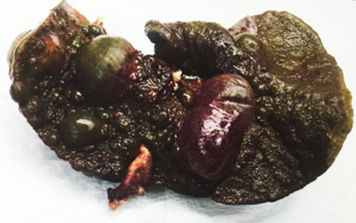 Child's resected liver