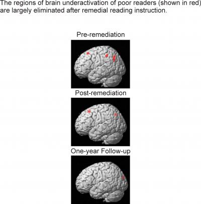 Brain Underactivation