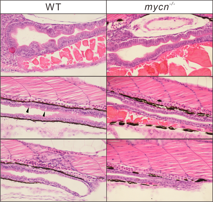 Rare Human Intestinal Disorder Is Due to Reduction in Protein Synthesis