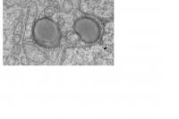 Electron Microscopy Visualization of AML Cells Treated with Flt3 Inhibitor Showing Mitophagy