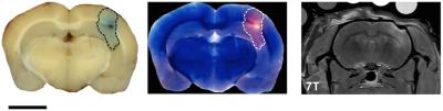 Pathologic and MRI Evidence of Blood-Brain-Barrier Disruption