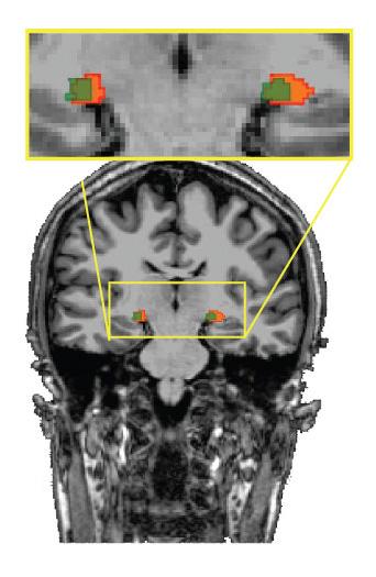 MRI of Human LGN