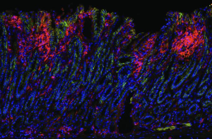 Stomach Cancer Cells