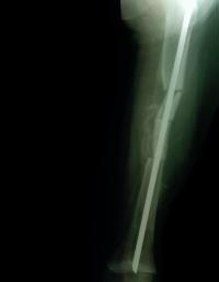 Long Bone Fracture of Individual with Hamamy Syndrome