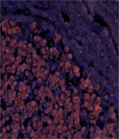 Some Deadly Breast Cancers Share Genetic Features with Ovarian Tumors