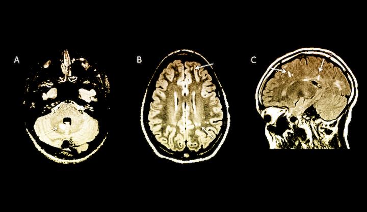 MS Risk in Children Spotted with MRI Brain Scans