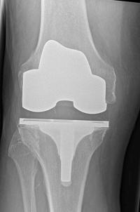 Knee Replacement X-ray
