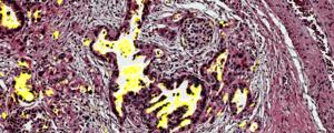 Pancreatic tissue with the biomarker CA199.STRA in yellow