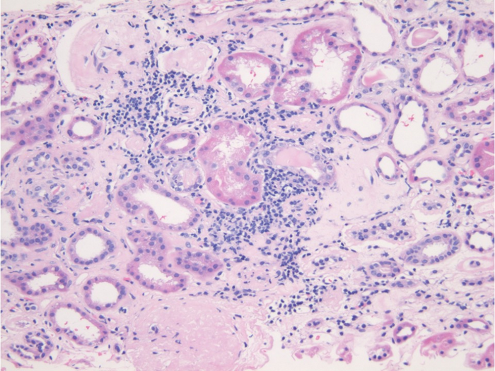aldosterone-linked-to-increase-image-eurekalert-science-news-releases