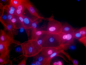 Breast cancer cells