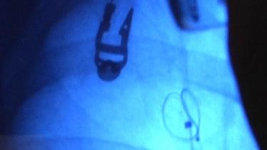 Coil for Emphysema Patients