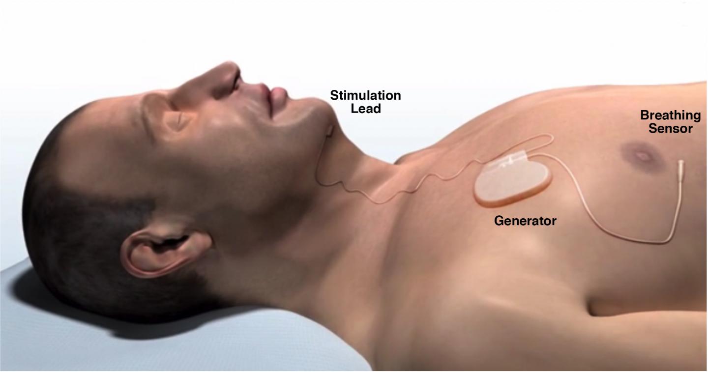 Inspire Upper Airway Stimulation System