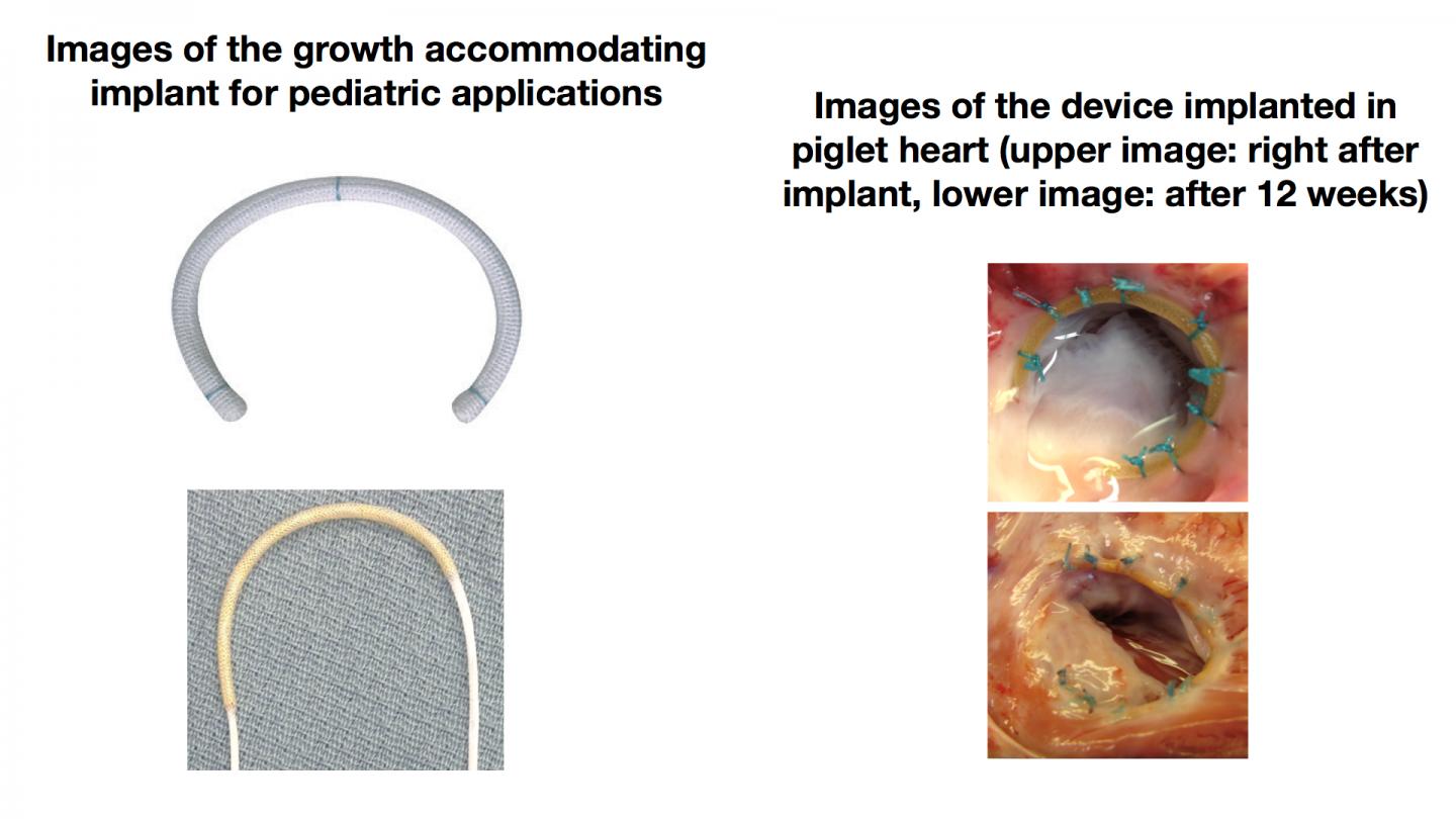 Surgical Implant that Grows with a Child Image