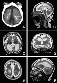 Microcephaly, Cortical Malformation, and Brain Calcification