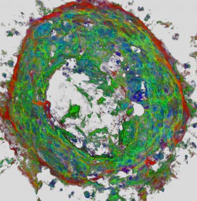 Choroidal Neovascular Lesion