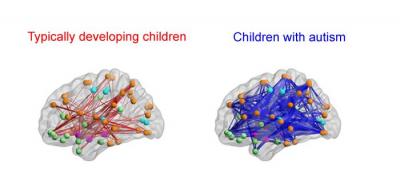 autistic brain vs normal brain