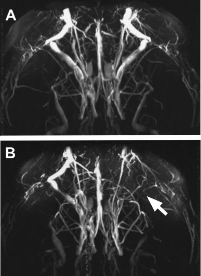 Blood Vessels in the Brain