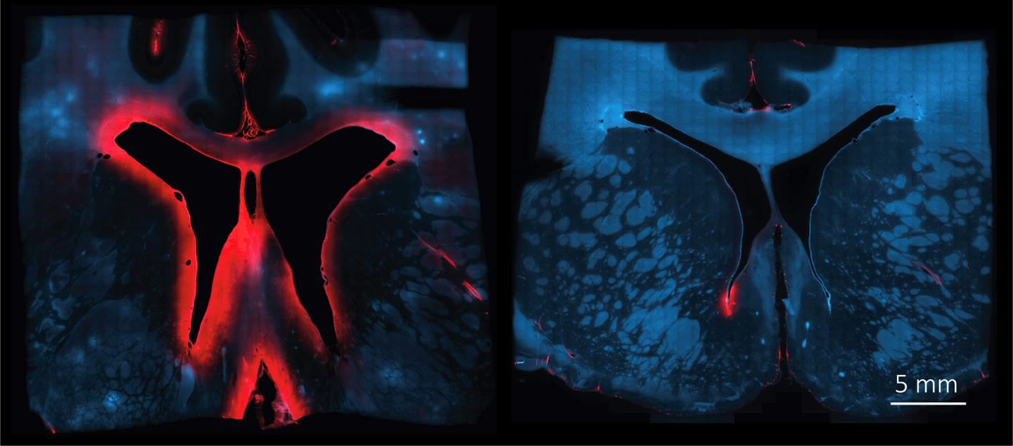 Red Hemoglobin after Cerebral Hemorrhage without (Left) and with (Right) Haptoglobin Treatment