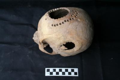 New Bone Growth at the Trepanation Site on the Side of the Head